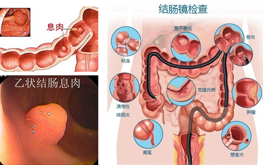 萎縮性胃炎真的“很嚇人”？看完這“七個事實”你就明白了