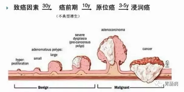 體檢查出腸息肉一定要切除！ 95%腸癌由它演變而來(lái)