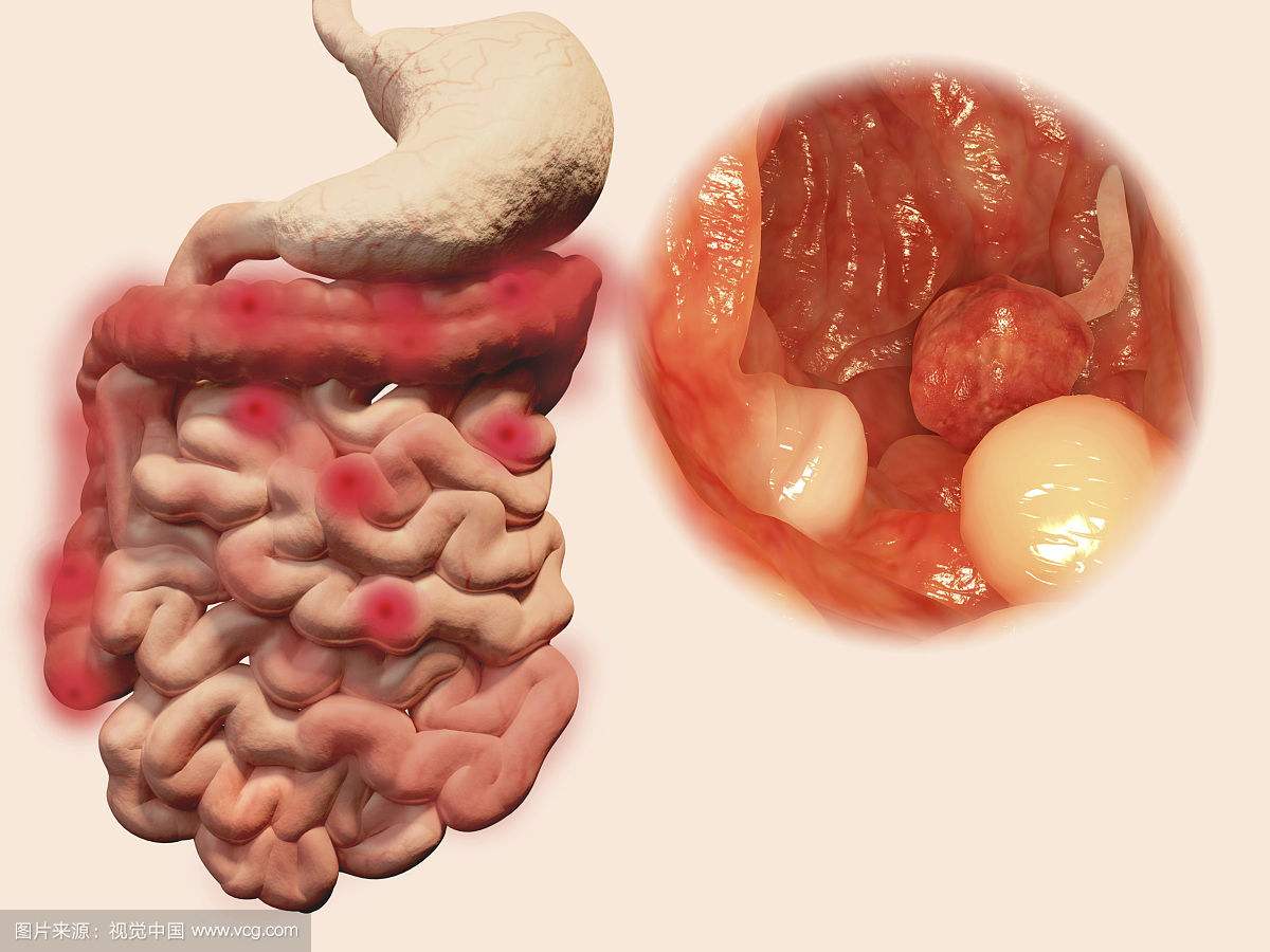 南寧慢性腸炎的費(fèi)用是多少錢