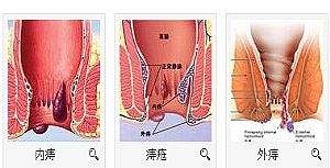 南寧治療外痔需要多少費用