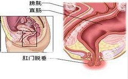 南寧治療脫肛哪家醫(yī)院好？南寧脫肛治療多少錢？